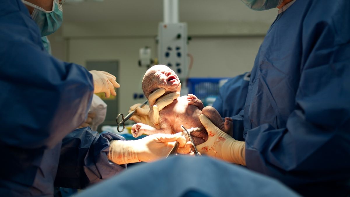 Ein Baby wird per Kaiserschnitt auf die Welt geholt.