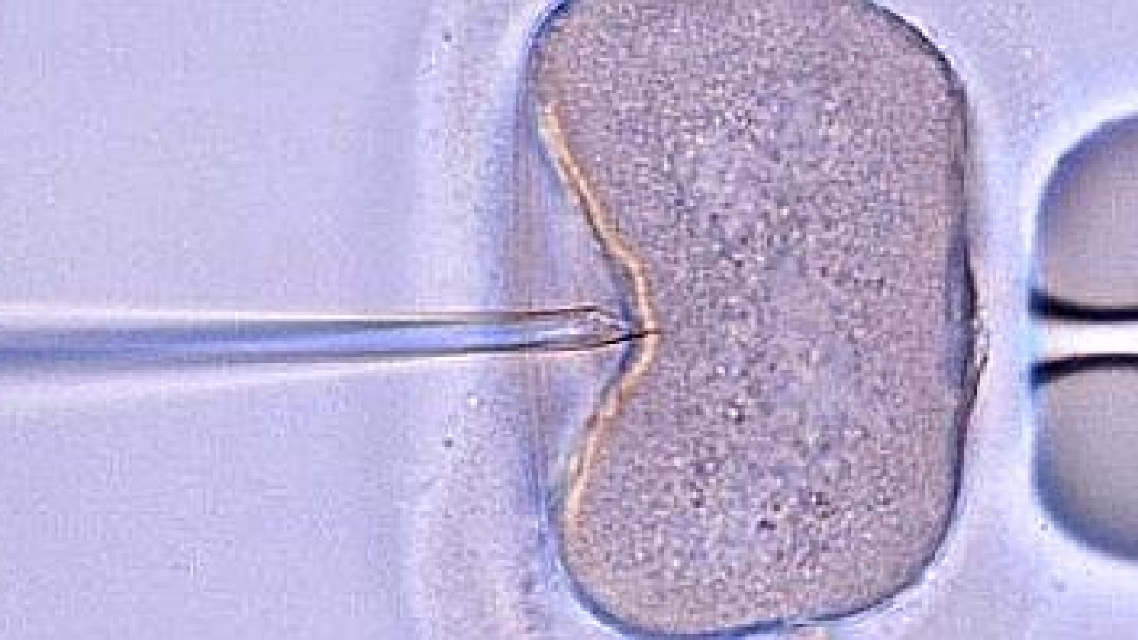 Künstliche Befruchtung kann Risiko sein