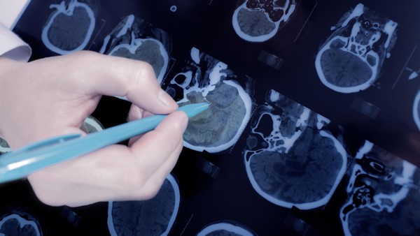 Vitamine gegen Parkinson? Studie zeigt überraschenden Therapieansatz