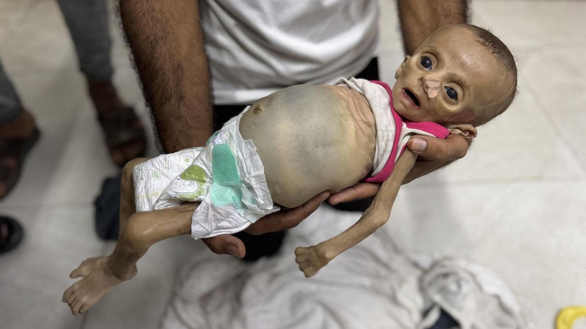 Hunger and malnutrition continue to claim lives in Gaza
