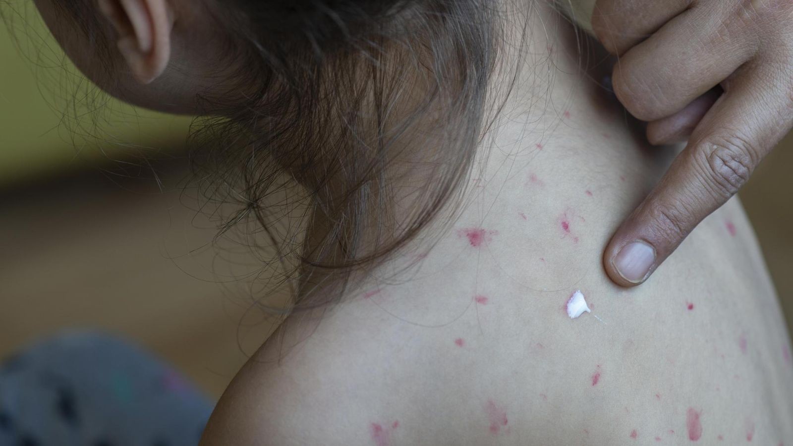 Gesundheitsbeh-rde-alarmiert-Londons-Schulen-droht-Masern-Welle