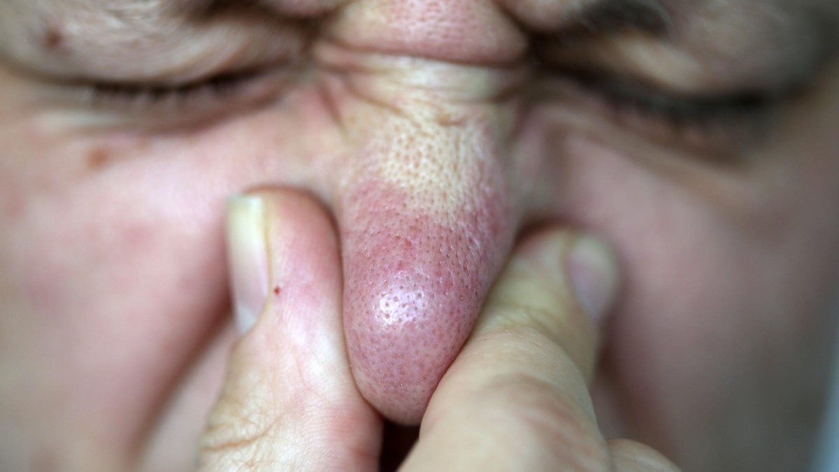 ARCHIV - 11.06.2013, Nordrhein-Westfalen, Köln: ILLUSTRATION - Ein Mann hält sich am 11.06.2013 in Köln (Nordrhein-Westfalen) die Nase zu. Igitt! Manche Fürze stinken wirklich fies.Mit einer Furz-App möchten Forscher herausfinden, wie Menschen furzen. (zu dpa: «Pupsen für die Wissenschaft») Foto: Oliver Berg/dpa - Honorarfrei nur für Bezieher des Dienstes dpa-Nachrichten für Kinder +++ dpa-Nachrichten für Kinder +++