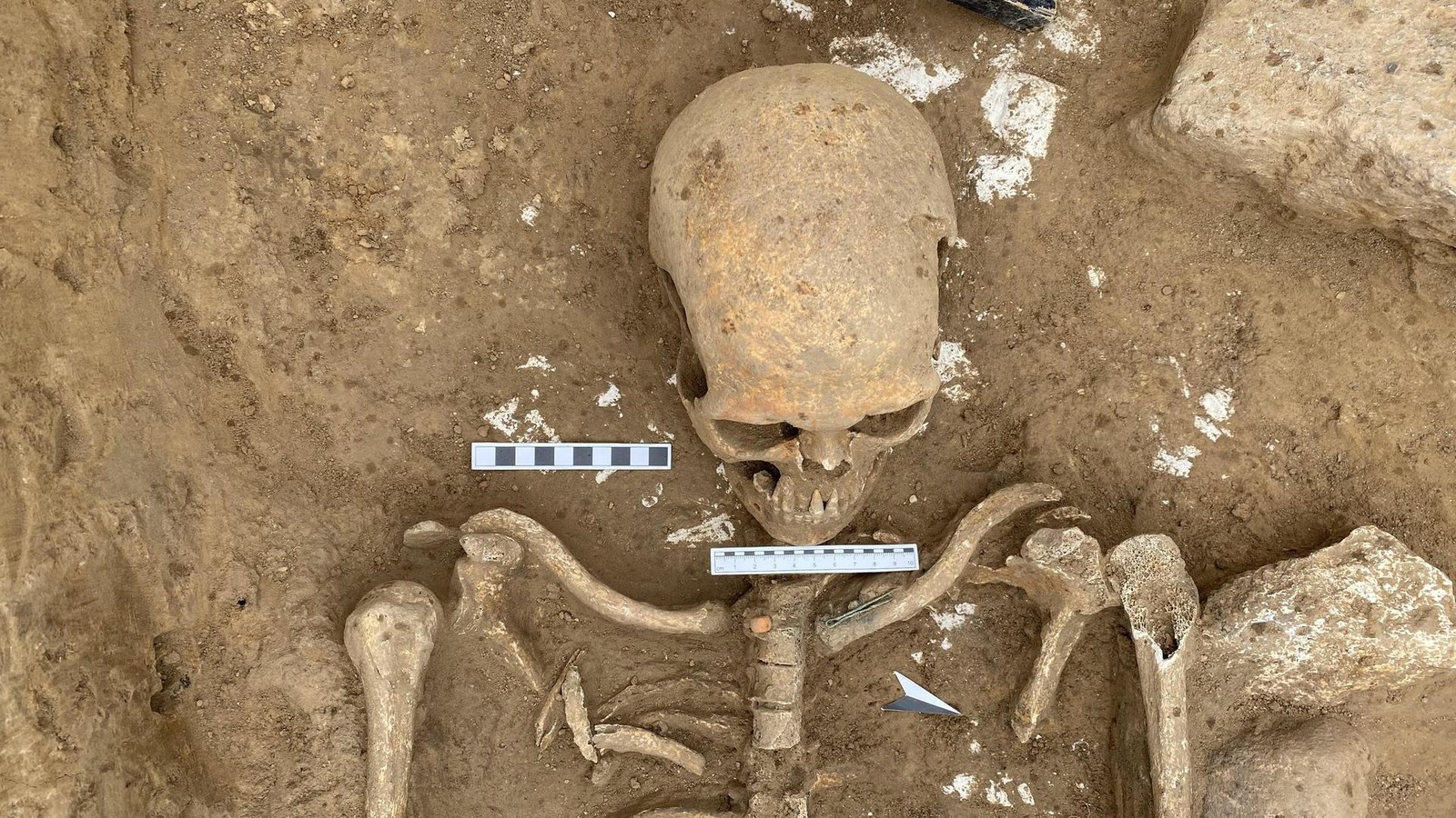 -berraschender-Fund-Zeigt-Skelett-aus-dem-Kreis-Peine-fr-hzeitliche-Operation-
