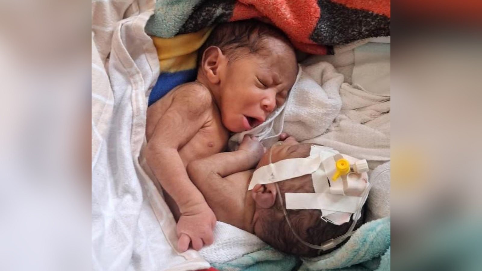 Siamesische-Zwillinge-K-nnen-deutsche-rzte-den-Babys-helfen-