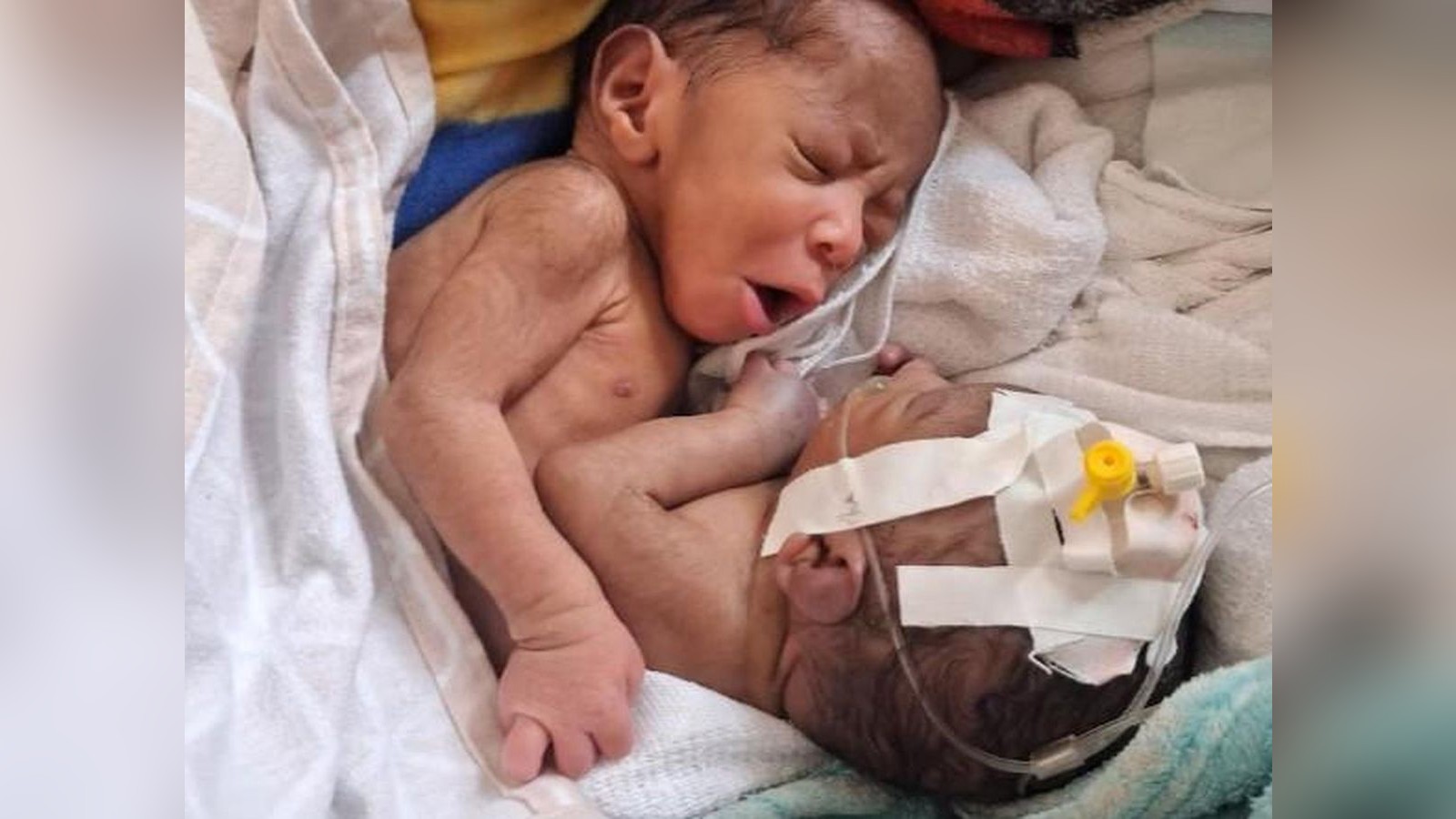 Siamesische-Zwillinge-K-nnen-deutsche-rzte-den-Babys-helfen-