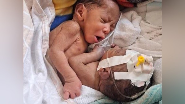 Siamesische Zwillinge: Können deutsche Ärzte den Babys helfen?
