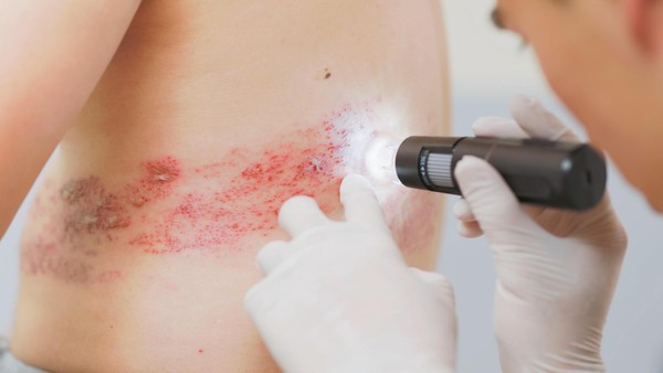 Gürtelrose-Impfung könnte vor Demenz schützen – Studie fasziniert