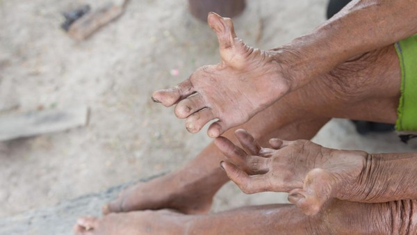 Nach 30 Jahren wieder Lepra in Europa – das sagen Experten zum Infektionsrisiko