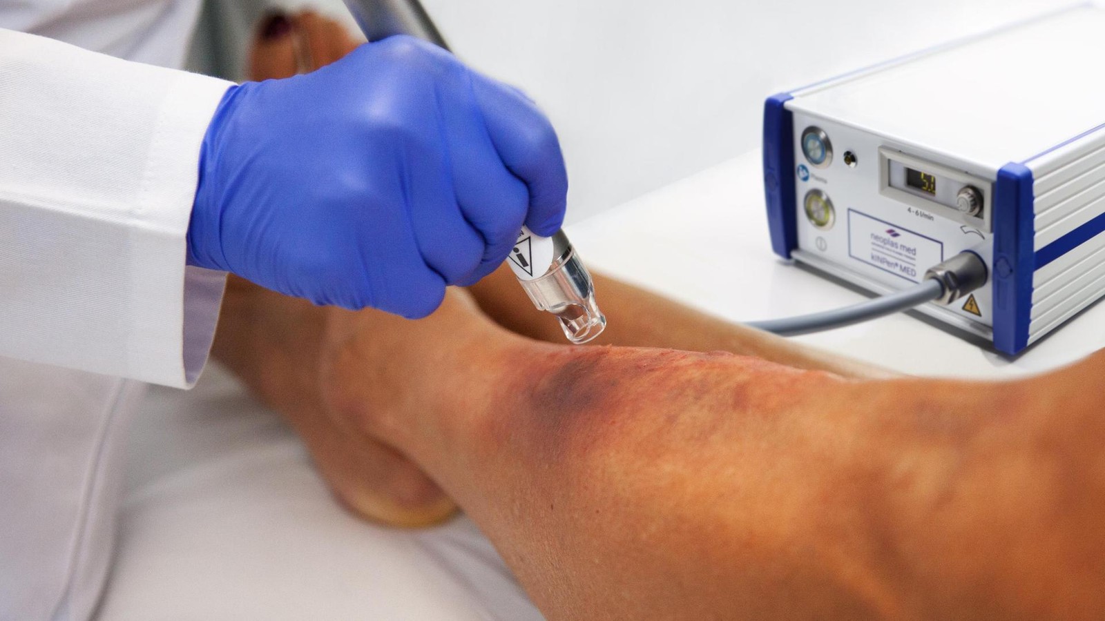 Wunden-verschlie-en-mit-Kaltplasma-Diese-Firma-liefert-Medizin-Hightech